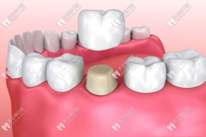 牙冠修復(fù)圖解