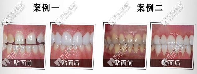 E-max鑄瓷貼面案例