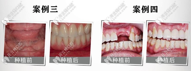 德國(guó)ICX種植牙案例