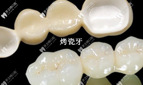 烤瓷牙和全瓷牙外觀