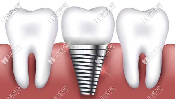 玉林口腔醫(yī)院種植牙價(jià)格表