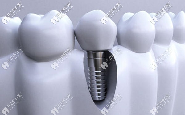 咸陽<!--<i data=20240703-sp></i>-->腔醫(yī)院種植牙的價錢