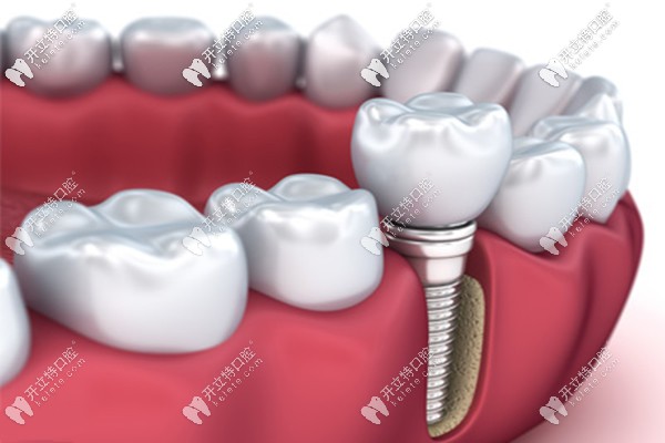 貴陽種植牙的價格