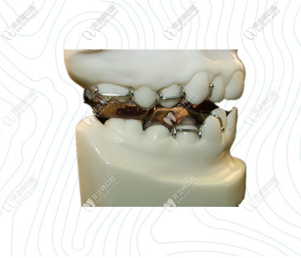 雙頜墊矯治器twinblock