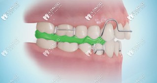twinblock矯治原理