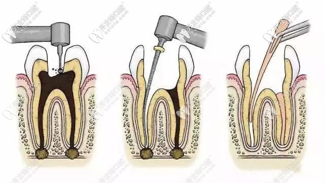殺死牙神經(jīng)