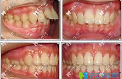 <!--<i data=20240703-sp></i>-->口腔醫(yī)院矯正牙齒案例