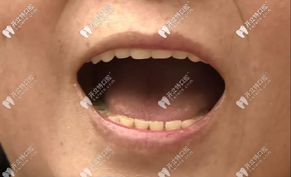 成都圣貝全口種植牙 成都圣貝全口種植牙