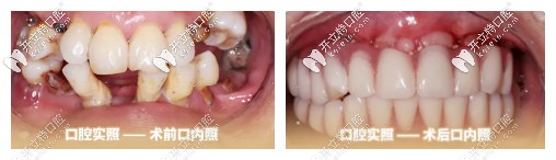 種植牙前后對比