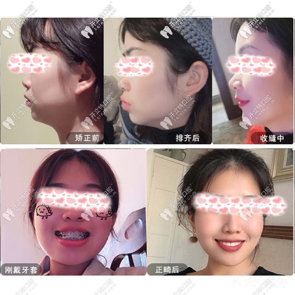 重慶樂(lè)樂(lè)欣口腔的盤(pán)龍店正畸收費(fèi)價(jià)格表?yè)岝r一覽