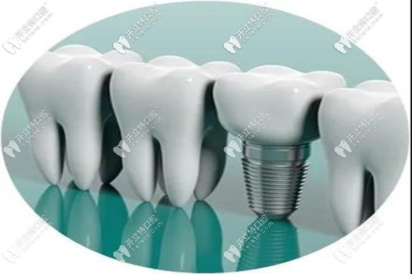 烏魯木齊市進口種植牙多少錢