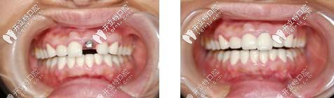 咸陽海濤口腔單顆種植牙