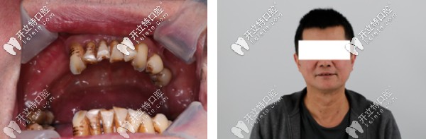 陳先生術(shù)前口內(nèi)照片
