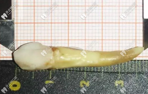 人的智齒較長(zhǎng)有幾厘米，3.72厘米的牙齒你見過嗎？