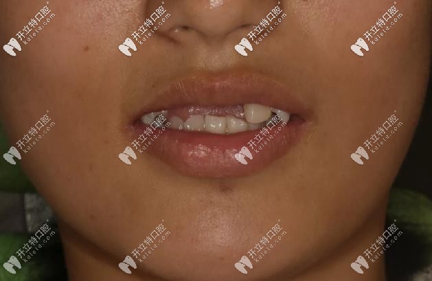 19歲<!--<i data=20240703-sp></i>-->生-摔斷4顆門牙、缺牙四年