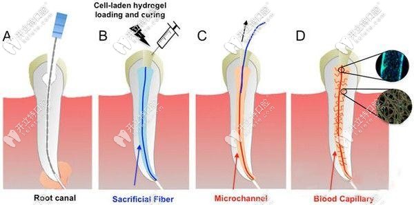 一個牙根做根管會便宜一些