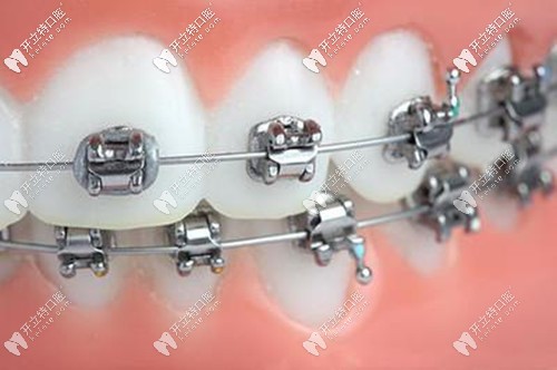 傳統(tǒng)金屬托槽矯正價(jià)格