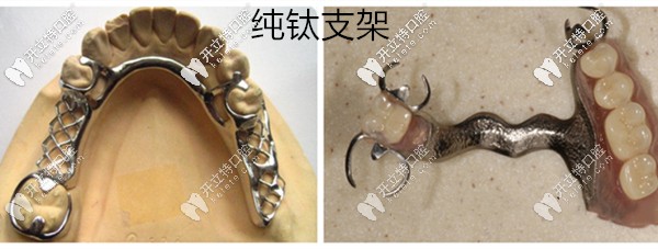 純鈦支架展示圖