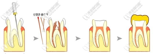 根管治療后一定要戴牙冠哦