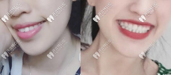 矯正前后的變化 矯正前后的變化