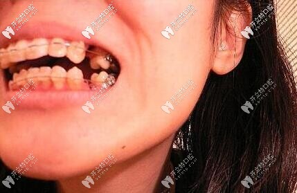 拔牙矯正 拔牙矯正