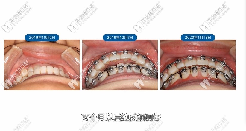 反頜調好圖片 反頜調好圖片