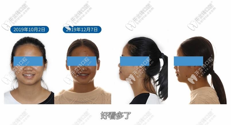 地包天矯正后也可以很漂亮 地包天矯正后也可以很漂亮