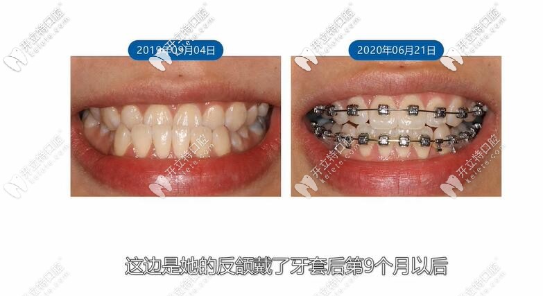反頜牙套9個月 反頜牙套9個月
