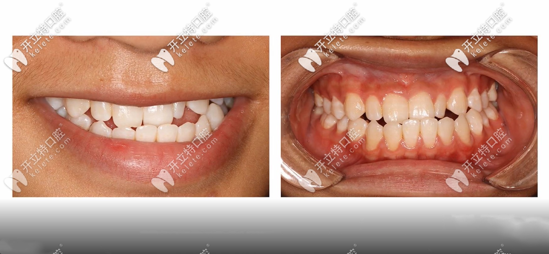 骨性三類凸嘴圖片 骨性三類凸嘴圖片