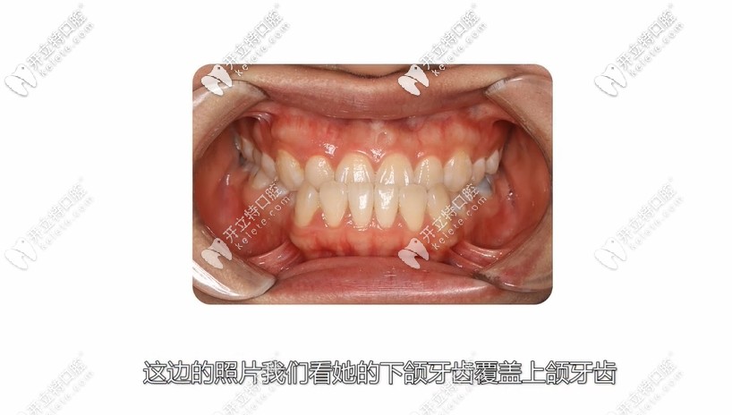 反頜地包天案例 反頜地包天案例