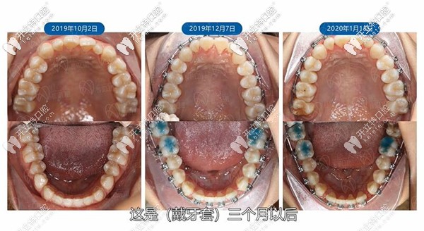 戴牙套3月以后 戴牙套3月以后