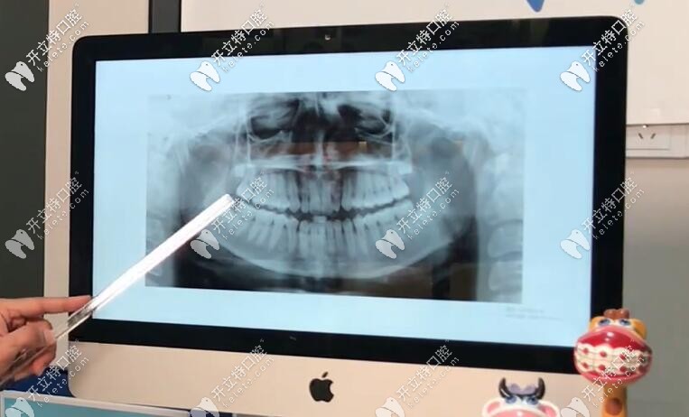 反頜牙片 反頜牙片