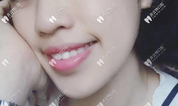 嘴凸案例 嘴凸案例