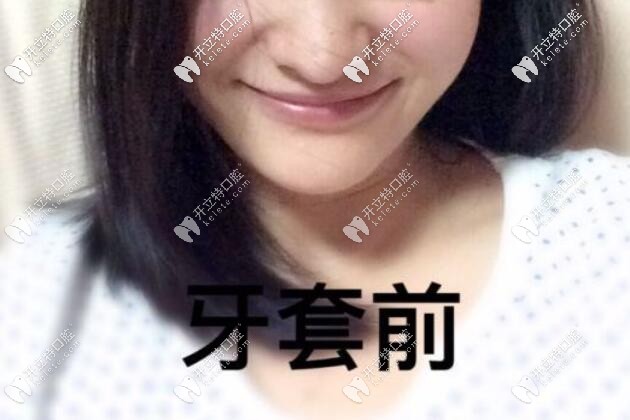 內(nèi)傾型三度深覆合矯正案例：拔牙后戴的是隱適美隱形牙套