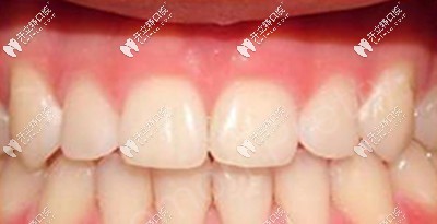 牙齒變整齊啦 牙齒變整齊啦