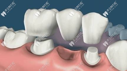 牙根壞死，做的烤瓷牙固定修復(fù)