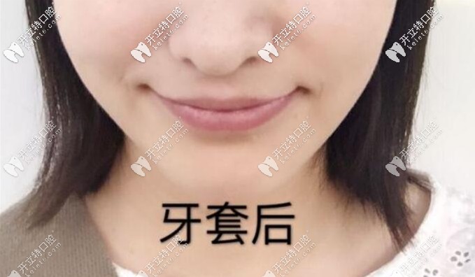 內(nèi)傾型三度深覆合矯正后效果圖 內(nèi)傾型三度深覆合矯正后效果圖