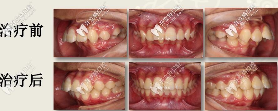 圣貝口腔何曉天交之案例