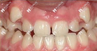 說(shuō)我是齙牙妹一點(diǎn)都不為過(guò)吧 說(shuō)我是齙牙妹一點(diǎn)都不為過(guò)吧