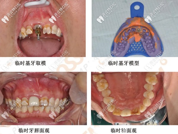 取模安裝臨時牙冠