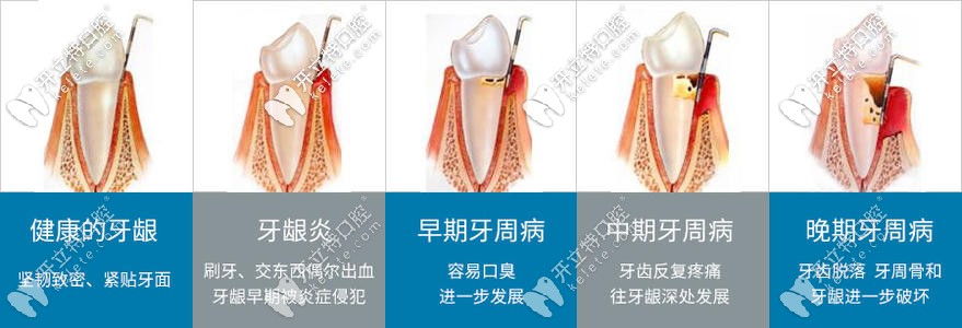牙周病的不同程度