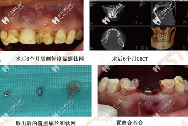 術(shù)后6個月的效果圖