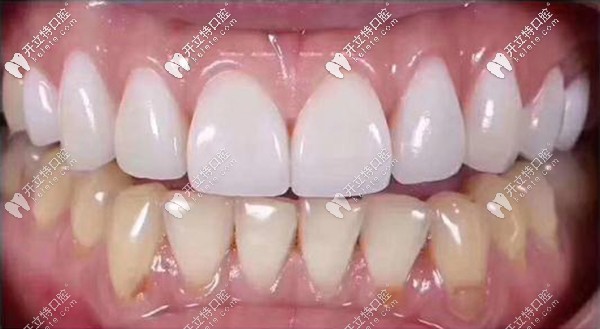 全瓷貼面和樹脂貼面的區(qū)別~拆過2次貼面全瓷貼面抗污性強(qiáng)