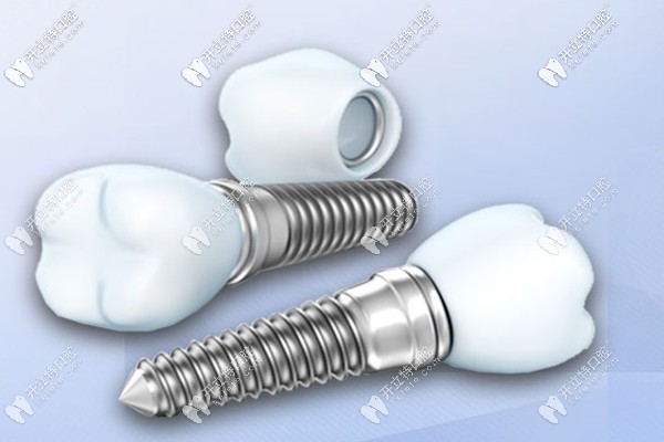 柳州做微創(chuàng)種植牙的價格