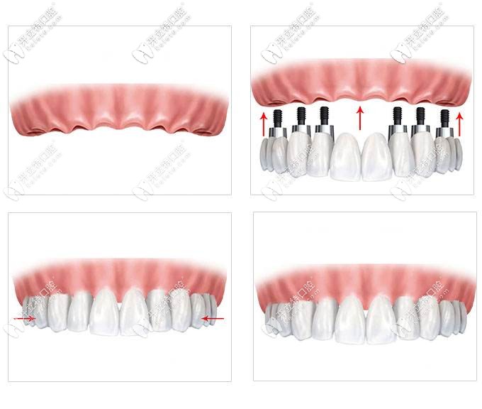 種植牙過程圖示