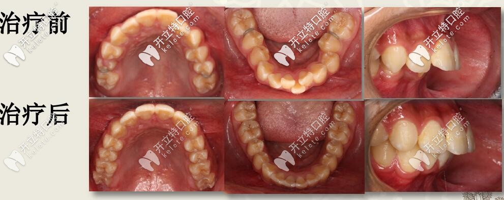 先圣貝牙科牙齒矯正案例