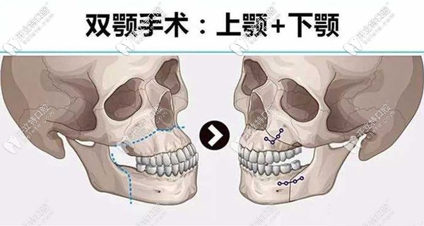 <!--<i data=20240703-sp></i>-->做骨性地包天矯正的費(fèi)用是多少？