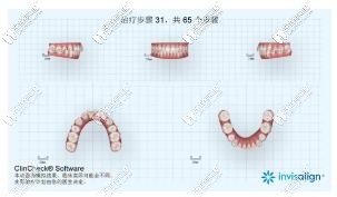 不管戴什么隱形牙套是不是都要重啟?隱形矯正重啟另收費嗎
