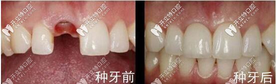 美奧口腔張書桓種植牙案例一