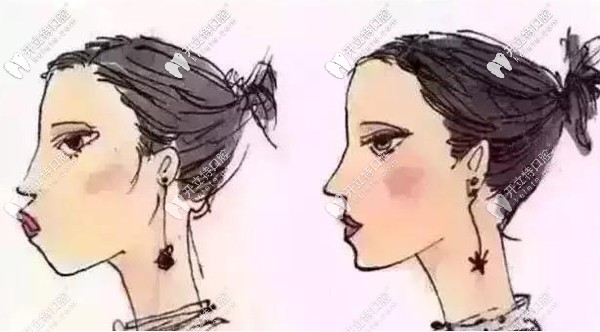 下頜后縮和正常面型對(duì)比效果圖